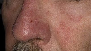 How to Treat Eczema on Face  Seborrheic Dermatitis Treatment  Face Eczema Treatment [upl. by Hardy]