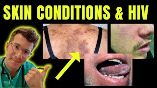 Doctor explains skin conditions associated with HIV  AIDS eg Kaposi sarcoma candida amp more [upl. by Clive]