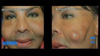 Fake Doctor Injecting Cement Fix A Flat Superglue in Patient Face WTF [upl. by Norret265]