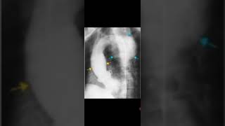 Syphilitic Aneurysm Aortography RadiologyAscending and Descending Aorta calcified Awerenes of all [upl. by Nnyloj490]