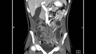 Abdomen Small Bowel EnteritisSeries of coronal sagittal volume rendered and MIP images1 of 6 [upl. by Leonid]