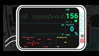 Ventricular Fibrillation [upl. by Debera]