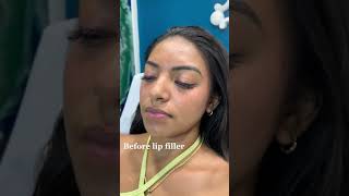 Stunning Lip Filler Transformation  Before amp After with Dr Dahabra in Florida shorts [upl. by Persse621]