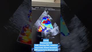 Chronic rheumatic heart disease CRHD [upl. by Ahsam576]