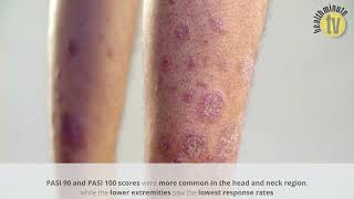 Ustekinumab less effective for psoriasis in lower extremities according to study [upl. by Enrichetta908]