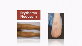 Erythema Nodosum  Causes amp Treatment [upl. by Nonah293]