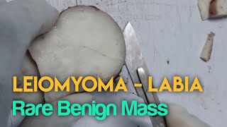 Leiomyoma  Labia Rare Benign Mass  Dissection essenceworld [upl. by Taite256]