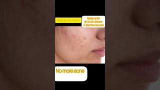 duac acne gel before and afterbest acne treatment by dermatologistacnetreatment trendingvideo [upl. by Clayton]