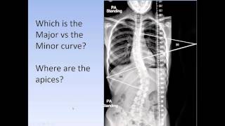 Scoliosis How to medically classify scoliosis the Lenke System for AIS [upl. by Baram313]