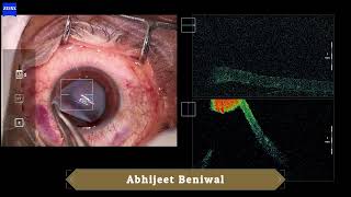 Automated Lamellar Therapeutic Keratoplasty ALTK [upl. by Urquhart443]