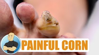 HUGE PAINFUL CORN REMOVAL WHATS UNDERNEATH [upl. by James]