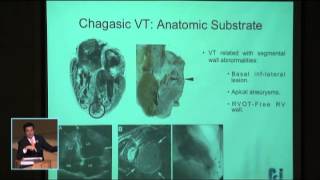 Manejo del paciente con arritmia ventricular quotchagásicaquot [upl. by Russ]