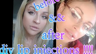 DIY LIP INJECTIONS AT HOME LIP FILLERS [upl. by Slinkman]