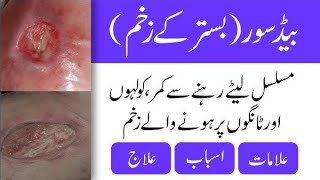 what is the Bed sore pressure sores ulcer Dr Health Officials [upl. by Aleinad]