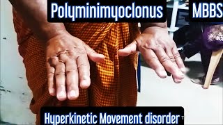 Polyminimyoclonus Hyperkinetic Movement Disorder mbbs medicine neetpg neet aiims usmle [upl. by Vinna608]