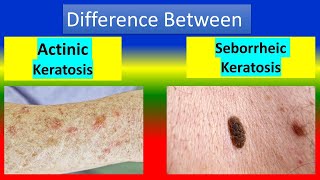 Difference between Actinic keratosis and Seborrheic keratosis [upl. by Leirbaj]