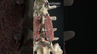 How MagnetOs can help you achieve a more predictable fusion  Medical Animation  MoA Animation [upl. by Aened]