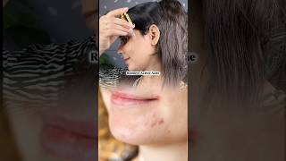 Shocking results remove acne amp acne marks in just 3 weeks skin acnetreatment [upl. by Ewolram]