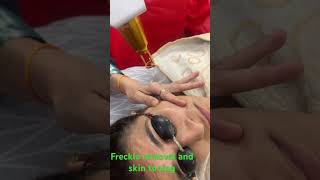 Freckle removal derma freckles skintoning [upl. by Arutak407]