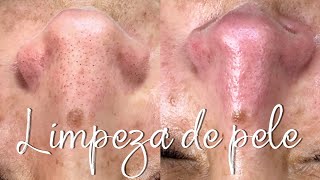 LIMPEZA DE PELE COM EXTRAÇÃO DE CRAVOS  KIT BIOAGE [upl. by Atiras]