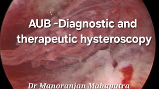 Abnormal uterine bleedingAUB Diagnostic and therapeutic hysteroscopy DTH Hysteroscopy [upl. by Geraint705]