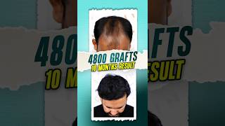 Hair Transplant in Bangladesh 4800 Grafts hairtransplant hair bangladesh shorts [upl. by Revkah]