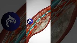 See how an Angioplasty and Stent Placement work in 3D animation [upl. by Vento]