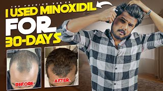 Harmful Effects Of MINOXIDIL 😵  30Days Of Usage Results [upl. by Adarbil552]