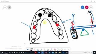 Ushaped maxillary major connector [upl. by Marlin]