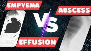 Empyema vs Lung Abscess vs Pleural Effusion on IMAGING [upl. by Ruon]