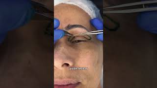 Explicando a Blefaroplastia superior [upl. by Alvina]