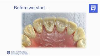 Endodontic treatment of the single rooted tooth Part 2 Access cavity preparation [upl. by Sartin]