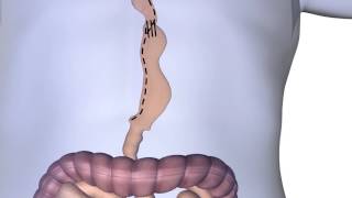 Esophagectomy Procedure Animation [upl. by Revolc]