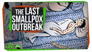 The Last Major Smallpox Outbreak in America [upl. by Yespmed]