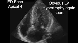 Hypertrophic Obstructive Cardiomyopathy with SAM [upl. by Mannuela756]