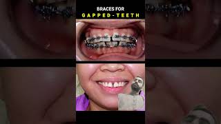 Braces for Gapped teeth 32 month Duration dentist braces orthodontist [upl. by Shakti579]