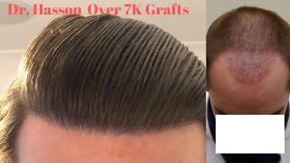 Over 7K Grafts Hair Transplant Results Real Patient Review MUST SEE [upl. by Malonis]