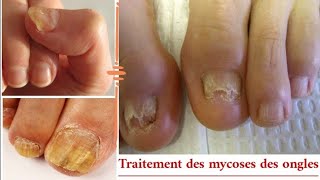 Traite les mycoses des ongles et traite les peaux mortes sous longle [upl. by Ihskaneem83]