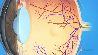 What is dry agerelated macular degeneration AMD [upl. by Merete]