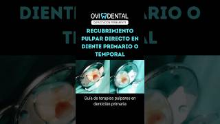 🚨 Recubrimiento pulpar directo en diente primario o temporal RPD DenticiónPrimaria [upl. by Tonya230]