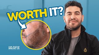 Beard transplant experience I 1 year results [upl. by Vasilis]