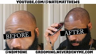 How To Get Your Hairline Back  From Bald To Edge Up  Hairline Restoration [upl. by Ainaled]