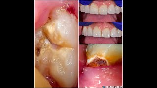 62 Chipped front tooth repair and wisdom teeth extractions [upl. by Liahkim]