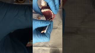 How to apply Povidone Iodine to teeth [upl. by Aurora447]