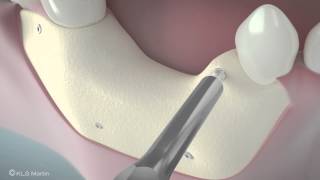 SonicWeld Rx® Dental – Shell technique for vertical defect augmentation [upl. by Sender]