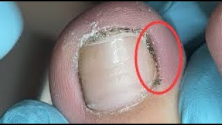 Best toenail dirt Cleaning [upl. by Alecia]