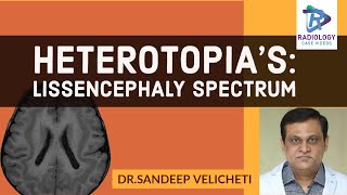 HeterotopiasLissencephaly SpectrumSandeep velichetiLissencephaly spectrum type 1 part2ped neuro [upl. by Yenruoj]