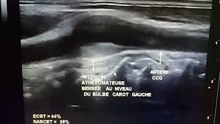 Échodoppler des TSA Sténose athéromateuse serrée [upl. by Eimia590]