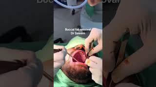 Buccal fat removal in Pakistan lahore [upl. by Magree]