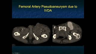 CT of the Abdominal Aorta Aneurysms Dissections and Repair [upl. by Shabbir]